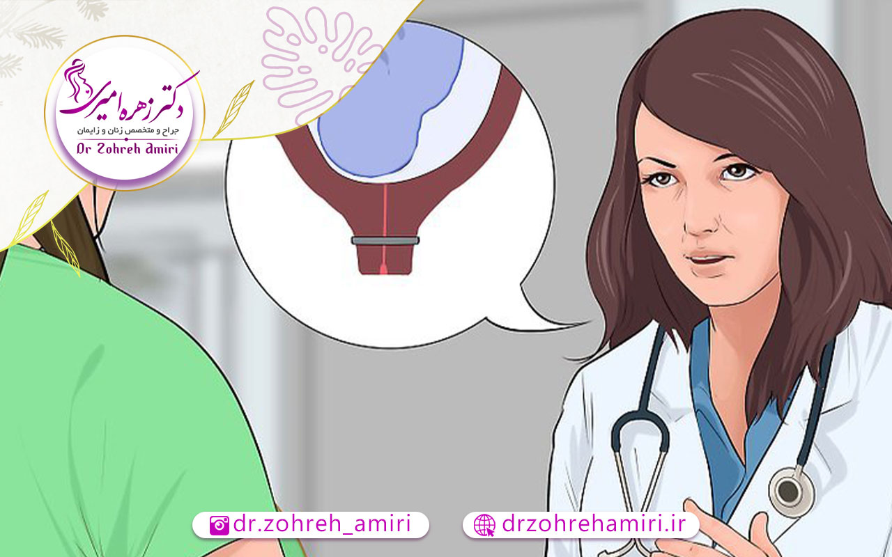 عمل سرکلاژ (دوختن دهانه رحم) 1 انواع عمل سرکلاژ