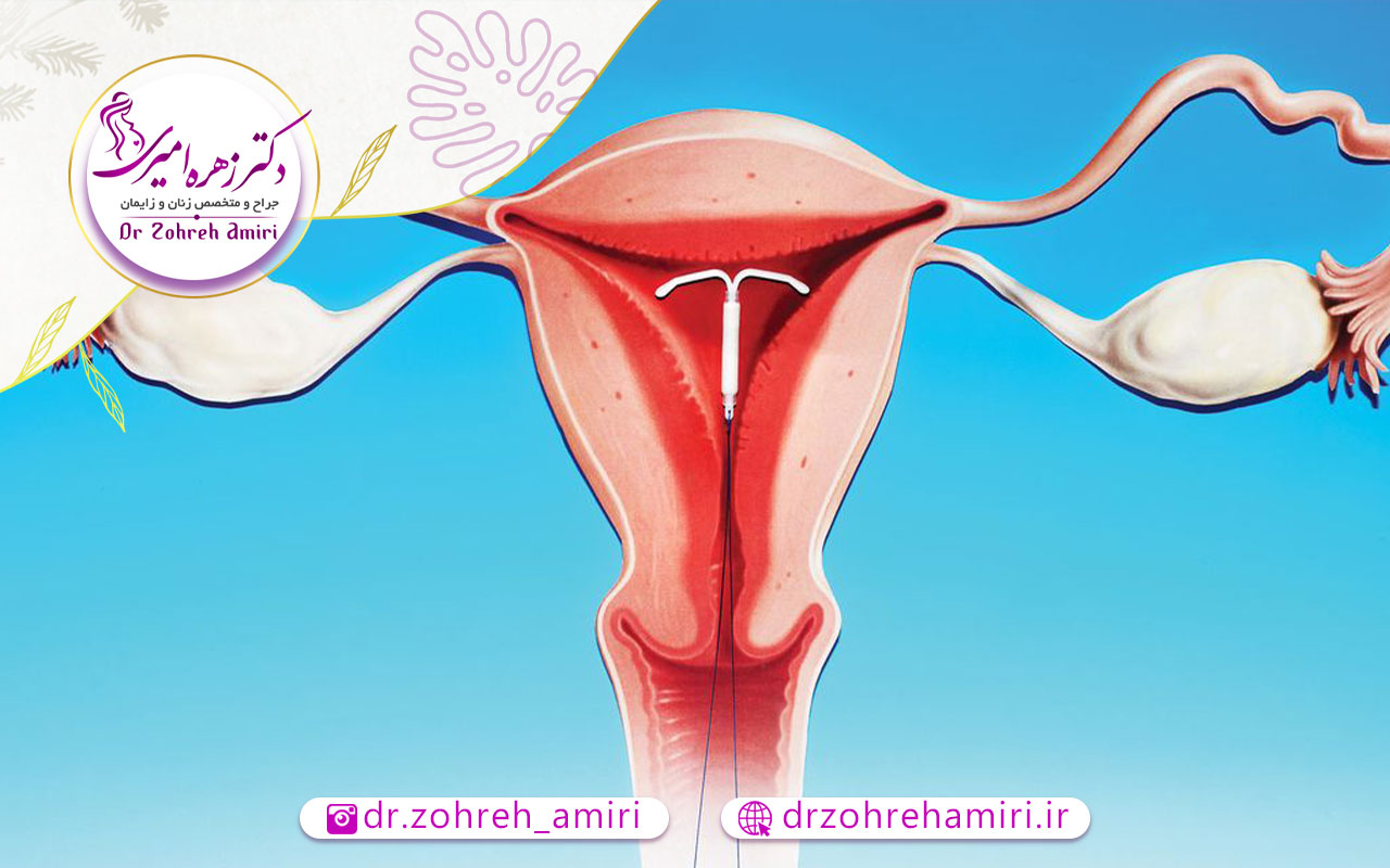 آی یو دی و قرار دادن آن در رحم 2 مزایای آی یو دی