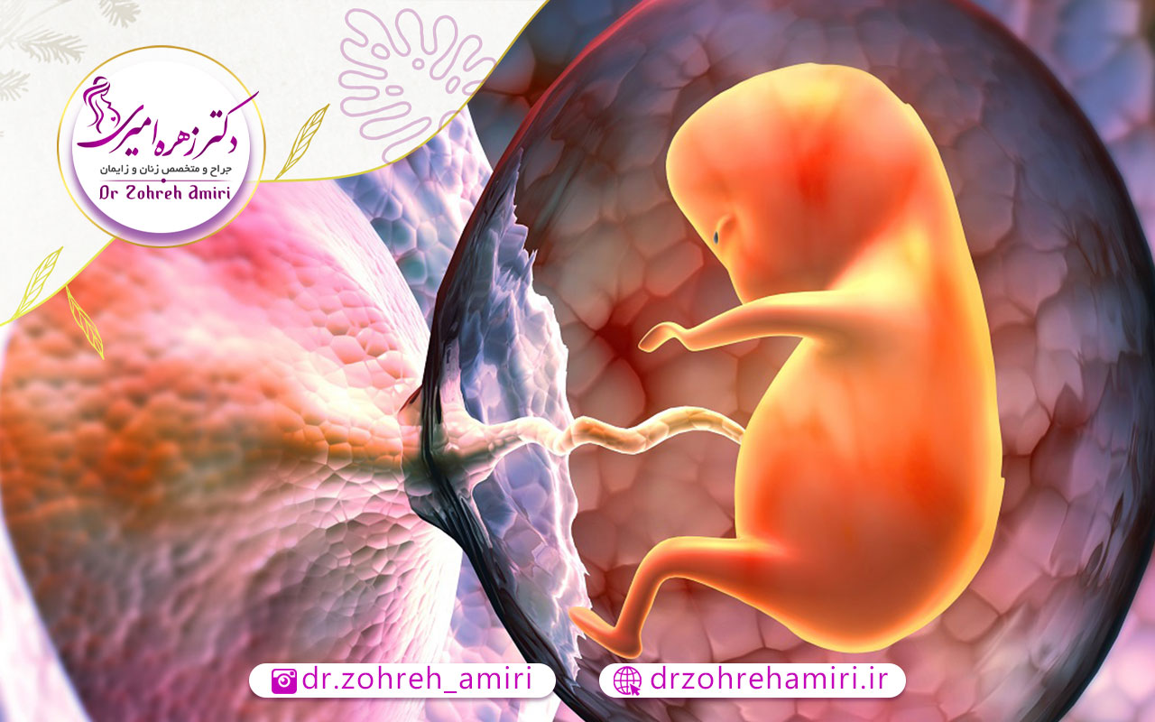 جفت پایین یا جفت سر راهی 4