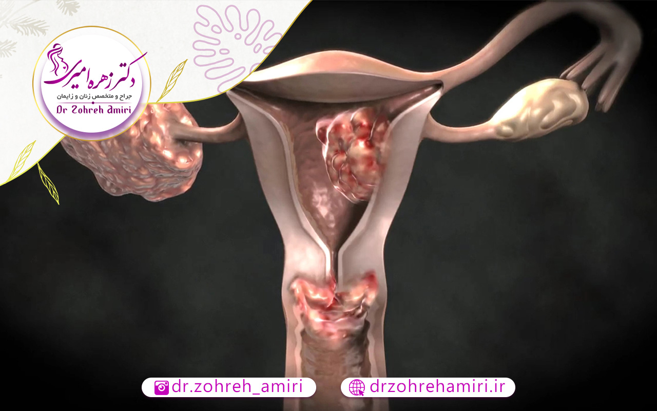 همه چیز درمورد عمل هیسترکتومی 3 آیا درمان افتادگی رحم به وسیله عمل هیسترکتومی صورت می گیرد؟