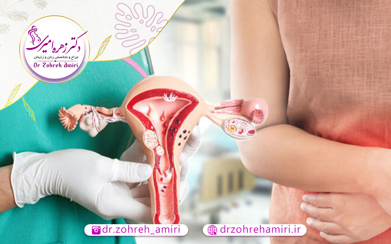 همه چیز درمورد عمل هیسترکتومی 2 آیا فیبروم های رحمی را با عمل هیسترکتومی رفع می کنند؟