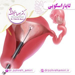 مقالات 7 لاپاراسکوپی چیست و چگونه انجام می شود؟