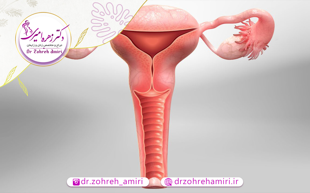 همه چیز درمورد عمل هیسترکتومی 1 جراحی هیسترکتومی برای چه کسانی است؟