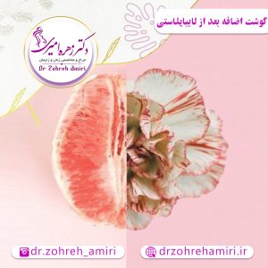 مقالات 5 گوشت اضافه بعد از لابیاپلاستی