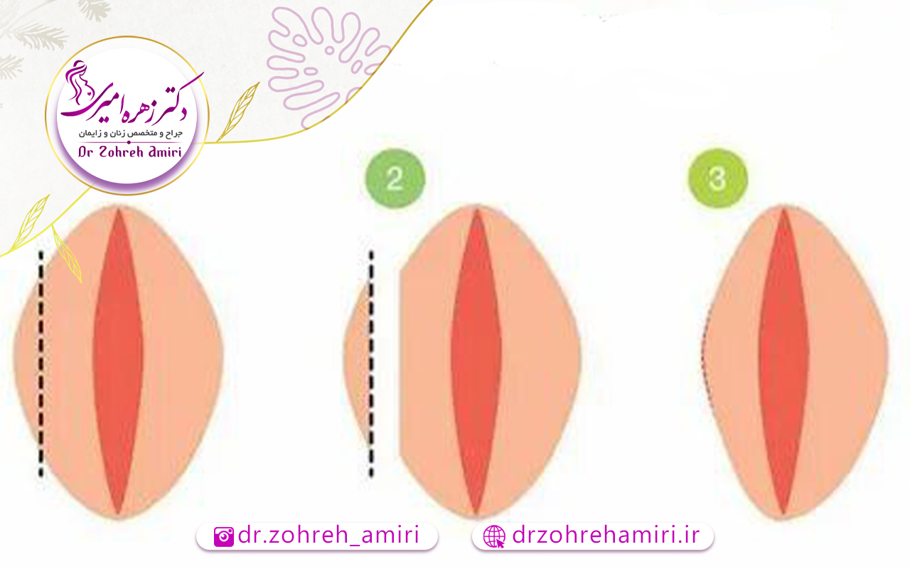 نحوه خوابیدن بعد از لابیاپلاستی 2 نحوه خوابیدن چه تاثیری بر نتیجه لایاپلاستی دارد؟