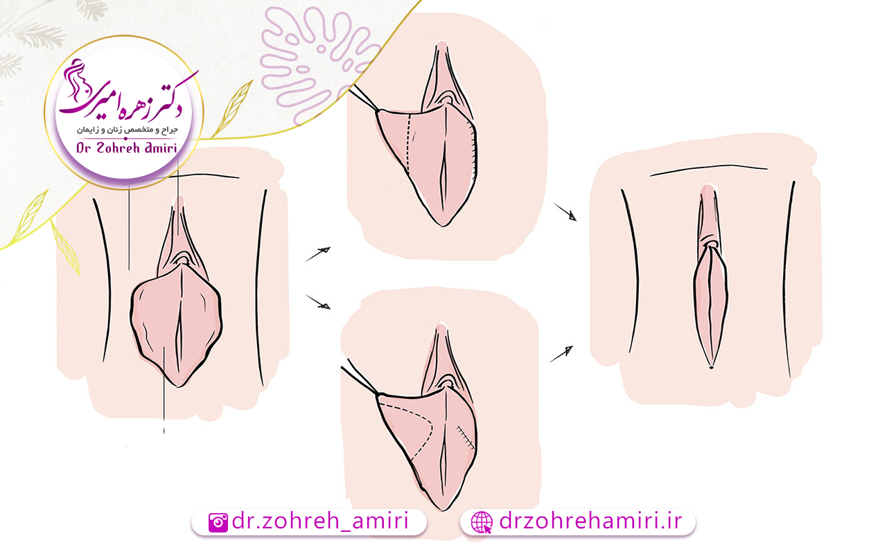 هزینه لابیاپلاستی 1 عوامل موثر بر هزینه لابیاپلاستی در تهران