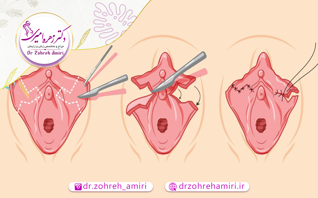 عفونت بعد از لابیاپلاستی 3 عوارض عفونت بعد از لابیاپلاستی