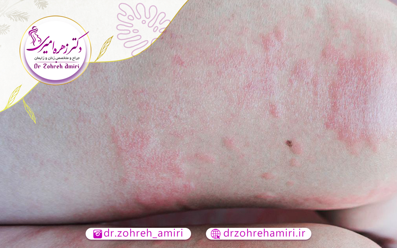 درمان بیماری مقاربتی سیفلیس 2 روش های تشخیص بیماری سیفلیس