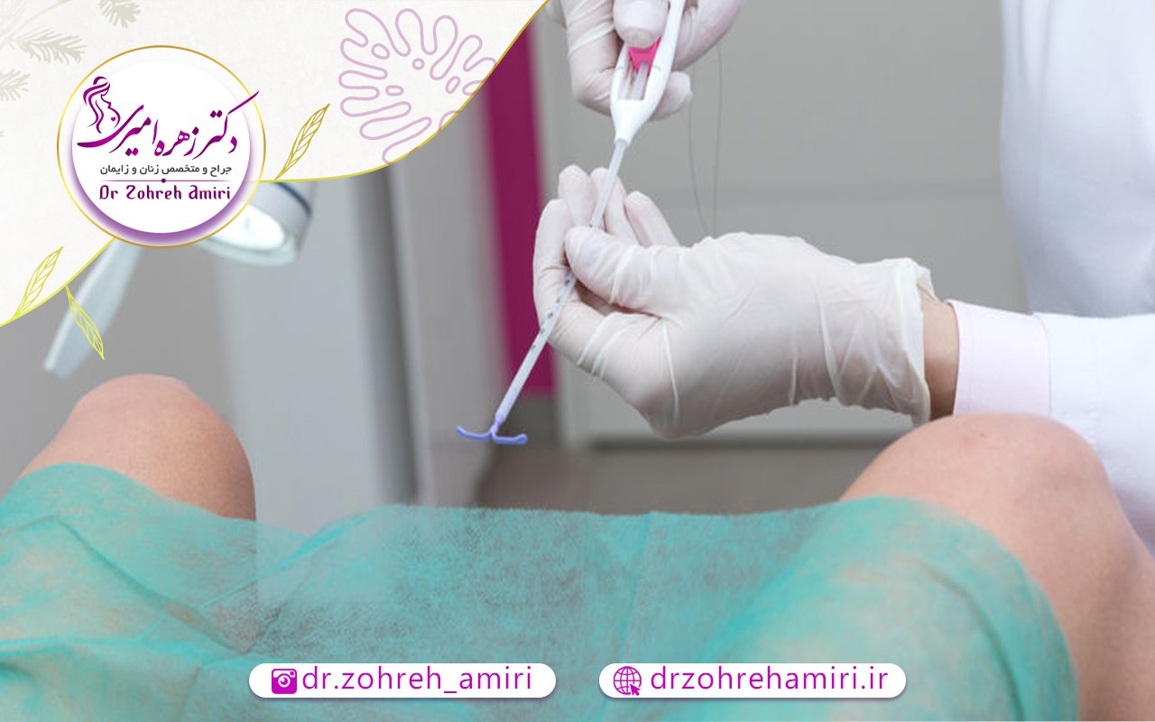 بهترین زمان گذاشتن آی یو دی 2 محدودیت های کار گذاشتن آی یو دی