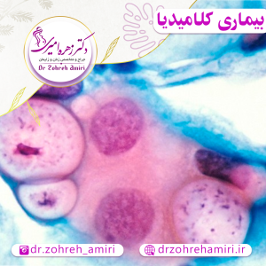 درمان بیماری مقاربتی کلامیدیایی