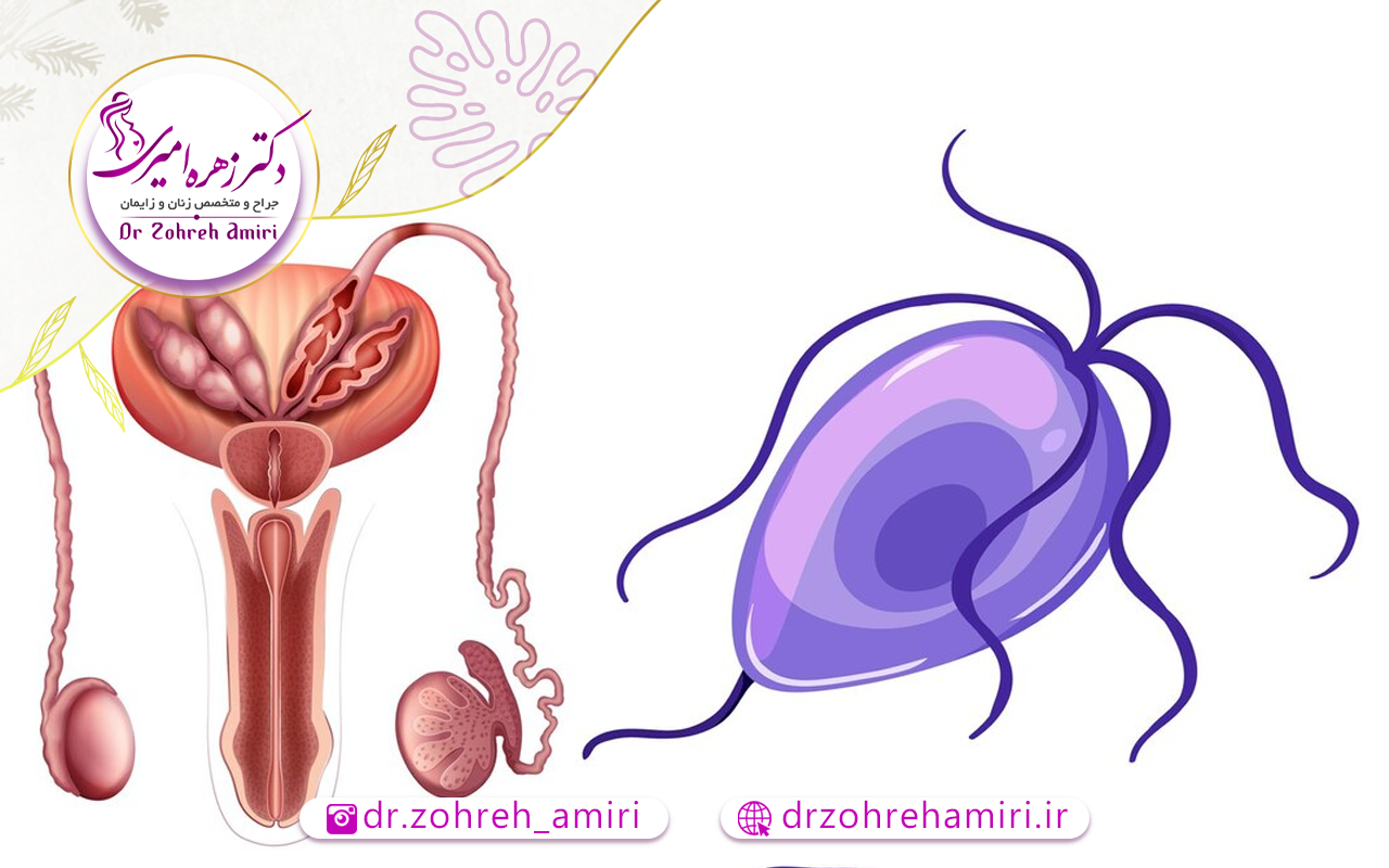 درمان عفونت مقاربتی تریکومونیازیس 1 علائم عفونت تریکومونیازیس در زنان