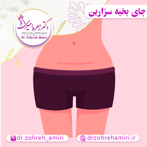 مقالات 10 جای بخیه زایمان سزارین