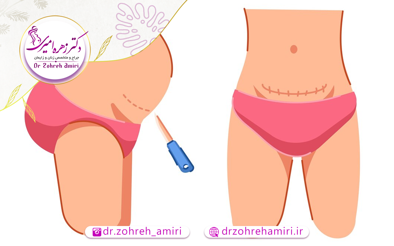 جای بخیه زایمان سزارین 2 روشی برای بهبود جای بخیه سزارین