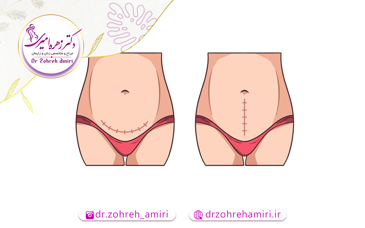 جای بخیه زایمان سزارین 1 علائم پارگی بخیه سزارین