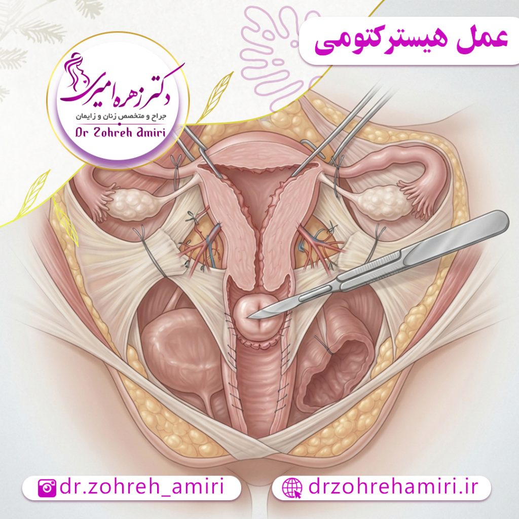 عمل هیسترکتومی