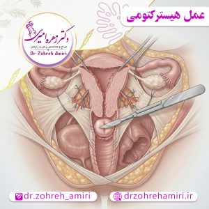 عمل هیسترکتومی